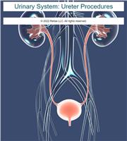 Urinary System: Ureter Procedures